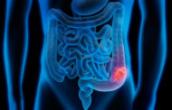 COVID-19 Disruptions in Screening Could Lead to More Colorectal Cancers and Deaths